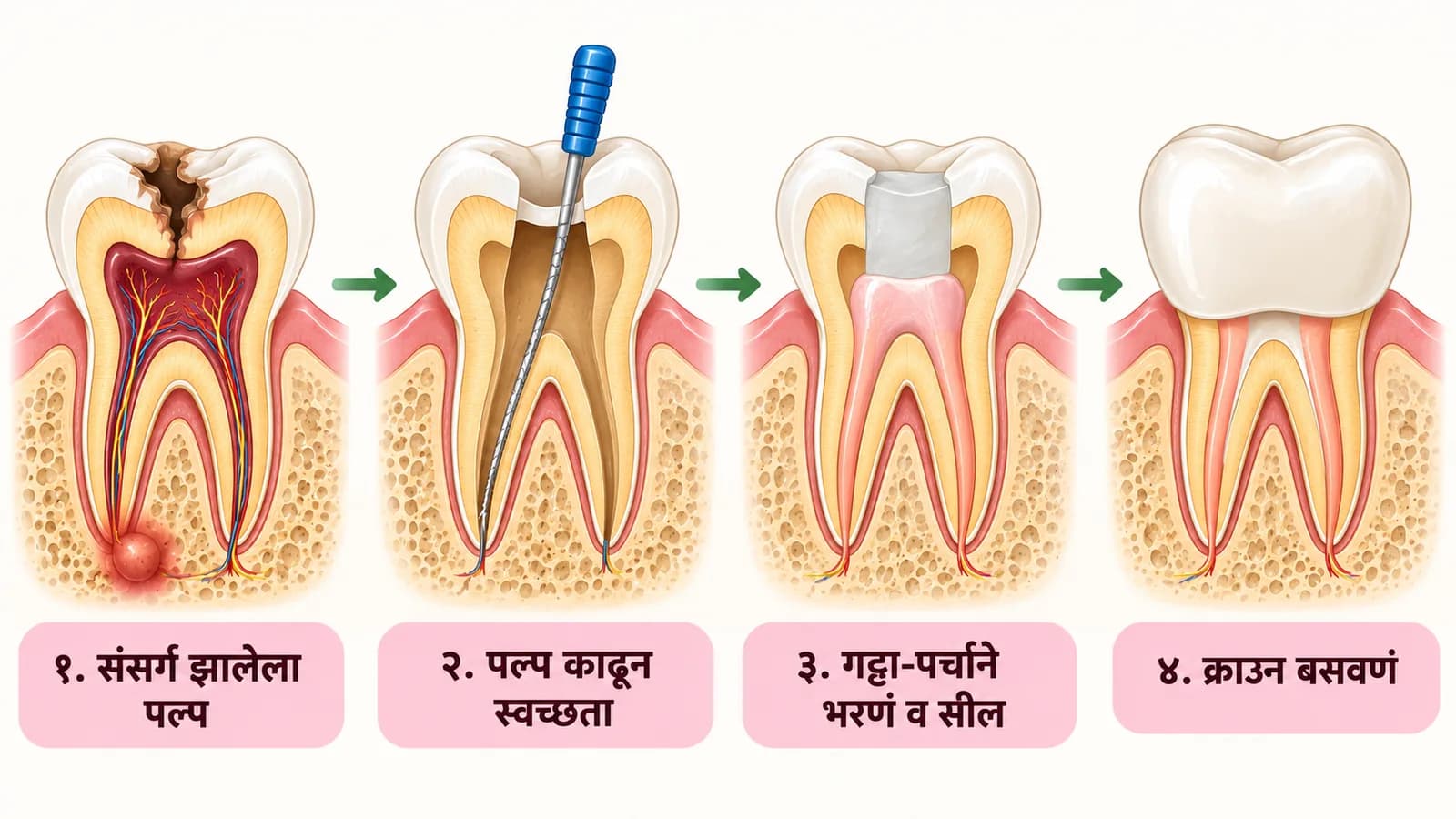 रूट कॅनाल उपचाराचे चार टप्पे दर्शवणारी आकृती — १. कीड पोहोचून संसर्ग झालेला पल्प, २. पल्प काढून नलिकांची स्वच्छता, ३. गट्टा-पर्चाने भरून सील करणं, ४. दातावर क्राउन बसवणं